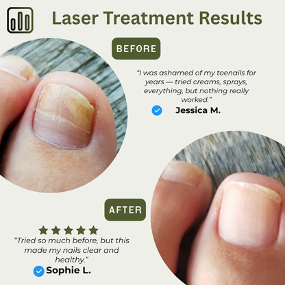 LAZRON - Fungus Care Laser Device